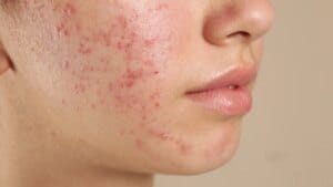 Acne