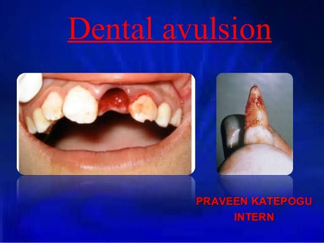 AVULSED TOOTH