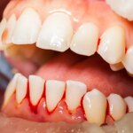 gum bleeding