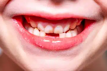 missing teeth