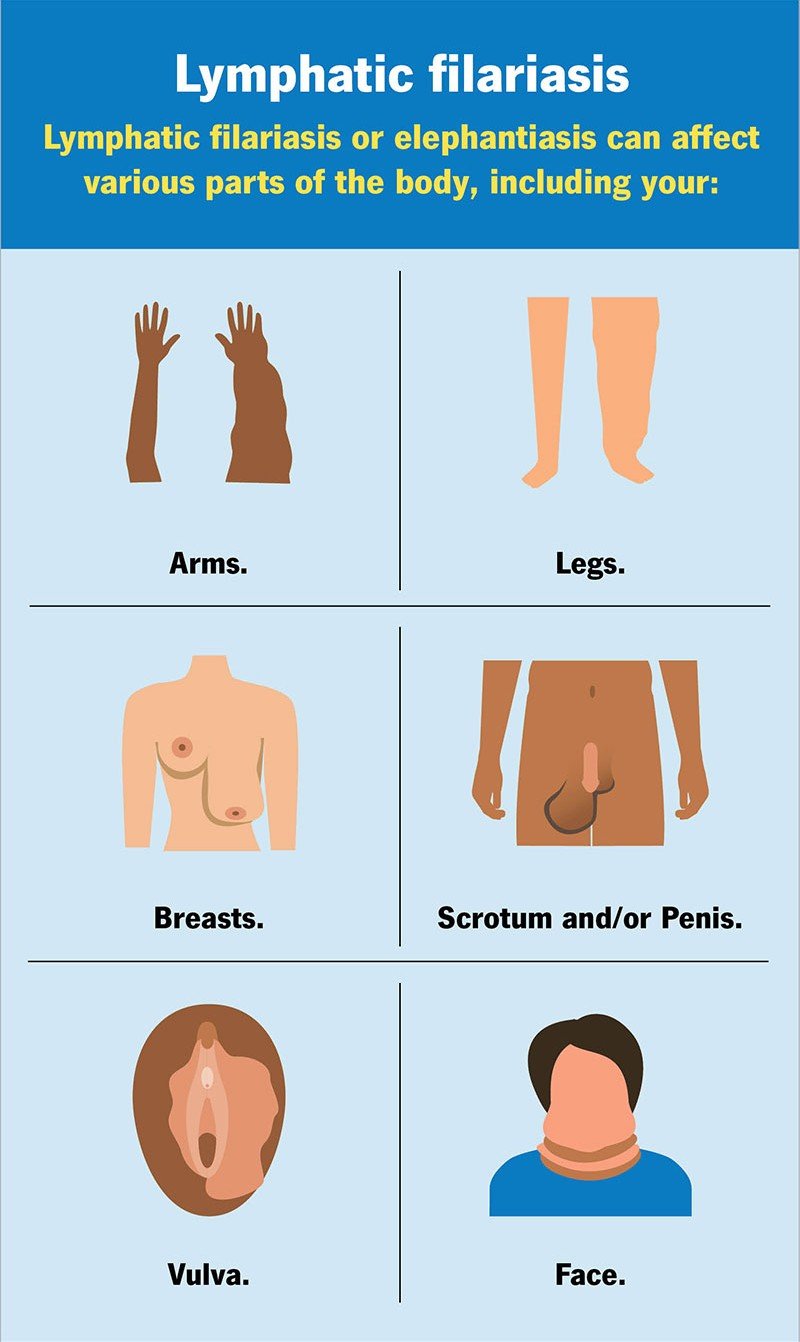 Filariasis elephantiasis inforgraphics