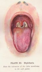 Diphtheria: Causes; Treatment and Care of the Patient