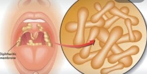 Diphtheria