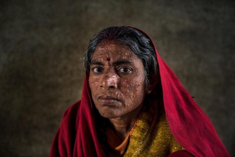 Kala Azar