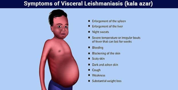 Kala Azar (visceral Leishmaniasis): Prevention, Causes, Treatment