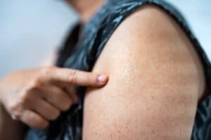Smallpox