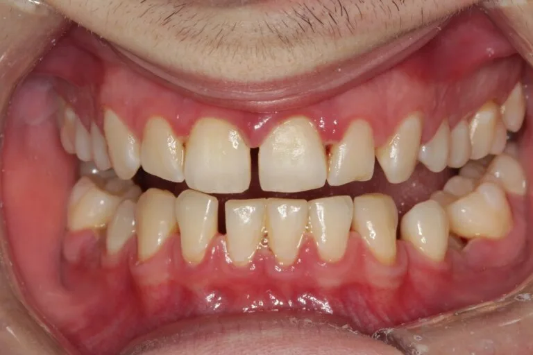 Acute necrotizing ulcerative gingivitis ( ANUG ) 1 Acute2Bnecrotizing2Bulcerative2Bgingivities