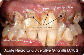 Acute necrotizing ulcerative gingivitis ( ANUG )