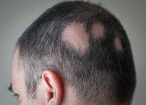Alopecia2Bareata