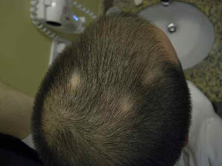 Alopecia areata: What is the, Diagnosis, and How is it Tested