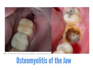 Osteomyelitis of the jaw