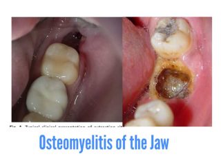 Osteomyelitis Of The Jaw