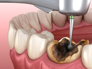 dental-pulpitis-pulp-diseases.jpg
