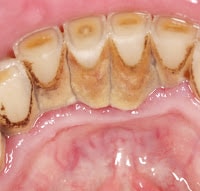 plaque Plaque dental problems
