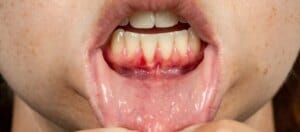 GUM2BRECCESSION