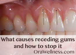 Gum Recession: Causes, Prevention & Treatment And Advice