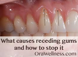 Gum Recession: Causes, Prevention &Amp; Treatment And Advice