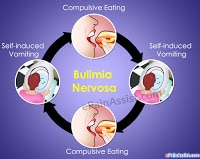 Bulimia Nervosa Bulimia nervosa