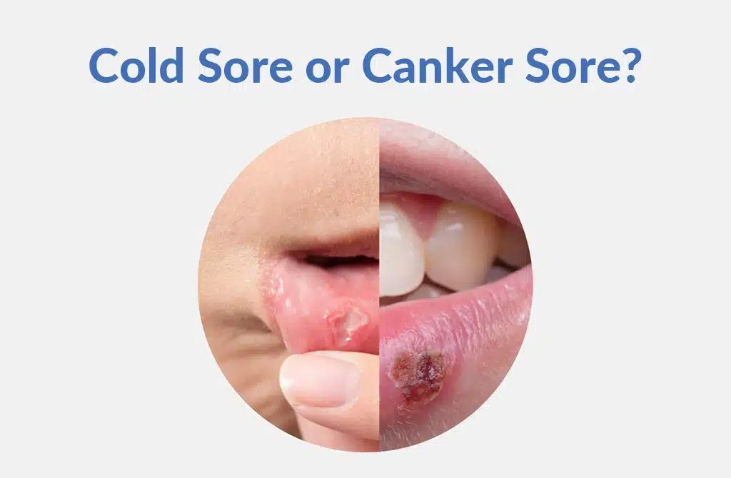cold sore vs canker sore