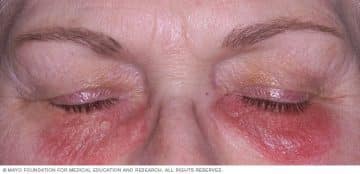 latex allergy: Image showing contact dermatitis on the face