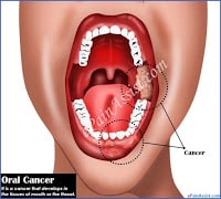 Oral Cancer