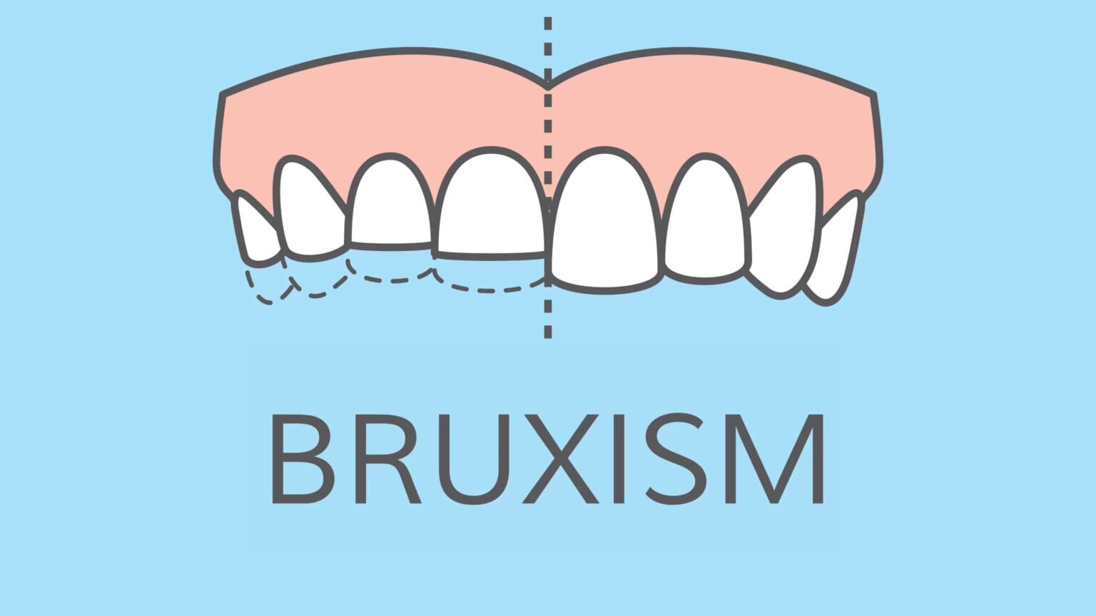 treatment for bruxism