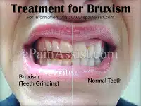 The Ultimate Guide to Understanding and Treating Bruxism
