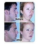 Corrective Jaw Surgery