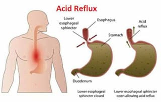 Acid Reflux Bile