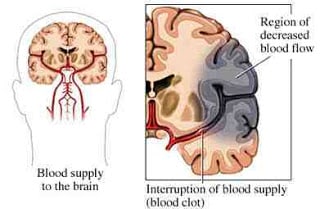 Foreign Accent Syndrome