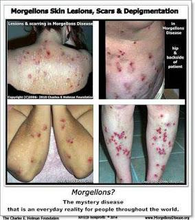 Morgellons Disease Treatment, Prognosis, Symptoms