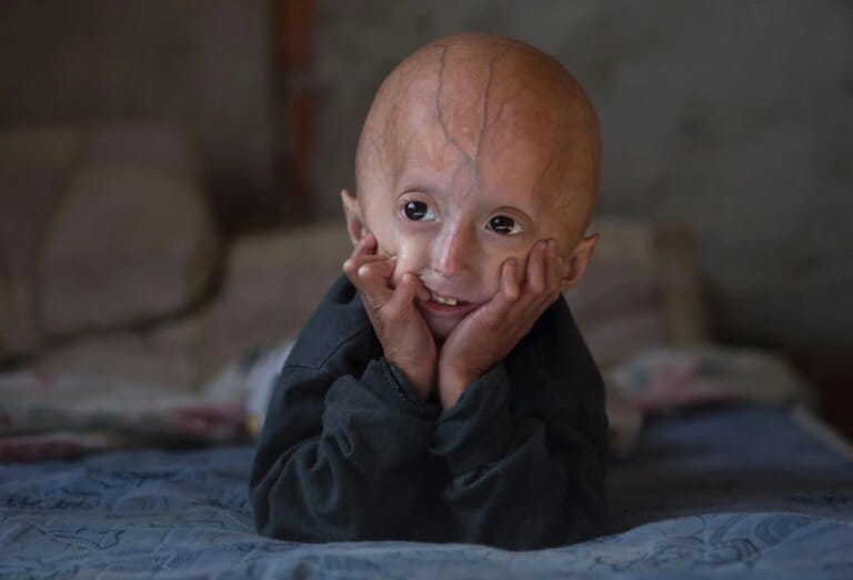 Progeria