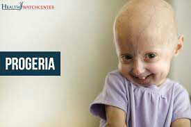 Progeria