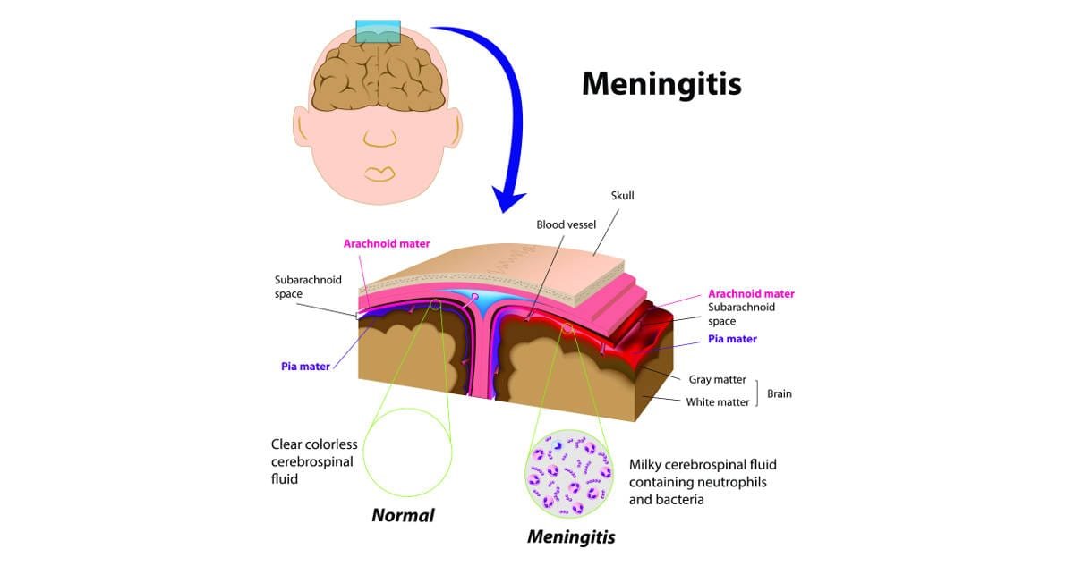 meningitis Meningitis, Causes, Symptoms, Treatment and Prevention