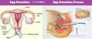 What to Know About Egg Donation