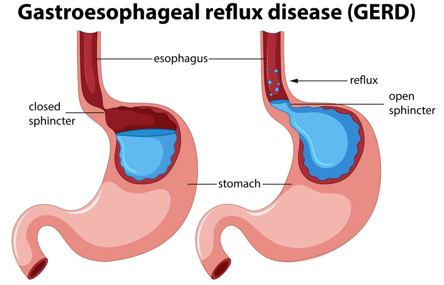 Importance2Bof2BResolving2BIndigestion2BIssues2Bto2BAvoi