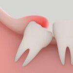 pericoronitis