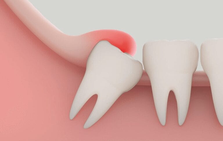 pericoronitis