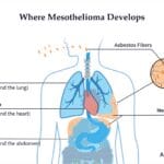 Mesothelioma