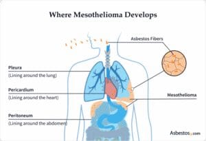 Mesothelioma