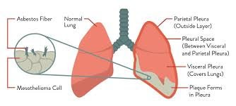 Https://Healthsoothe.com/Mesothelioma-Health-Resources-And-Useful-Cancer-Links/