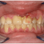 NECROTIZING2BULCERATIVE2BGINGIVITIS