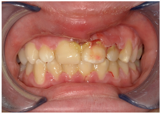 NECROTIZING ULCERATIVE GINGIVITIS