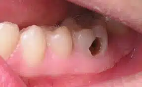tooth decay