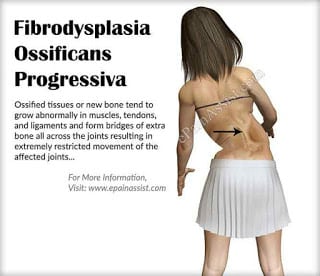 Common Aftermaths That One Must Know About Fibrodysplasia ossificans progressiva (FOP) disease fibrodysplasia-ossificans-progressiva