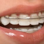 inman aligner