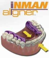 Top 5 Benefits to Straightening Teeth with Removable Aligners