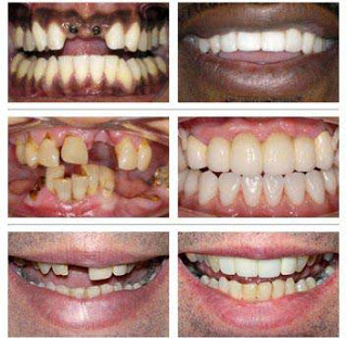 dental implants long island make your smile long lasting with dental implants