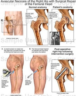 Avascular Necrosis of the Right Hip with surgical repair of the femoral head Avascular necrosis: causes, symptoms, treatments, prevention and more