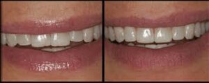 Enameloplasty2BTooth2BReshaping